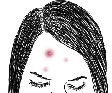 this is an illustration of a face with acne on it and the illustration is black and white.